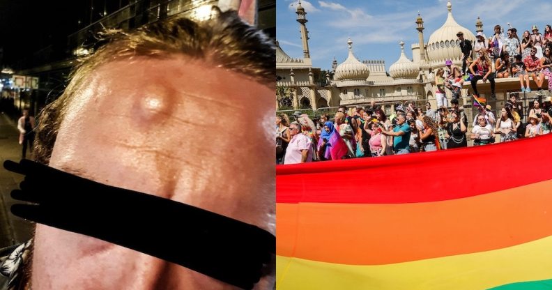 The customer's injuries side-by-side with a photograph of Pride goers in Brighton