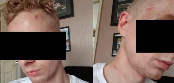 Two side by side photos of one victim of the homophobic attack in London, showing his injuries but censored to ensure anonymity