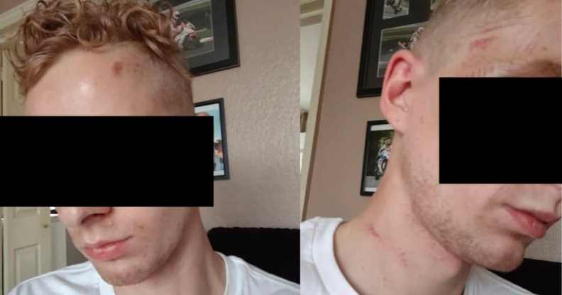 Two side by side photos of one victim of the homophobic attack in London, showing his injuries but censored to ensure anonymity