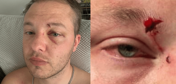 Ben Wearing injured face