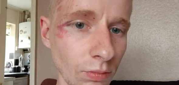 In this photograph, Nathan Esslemont can be seen with wounds on his face