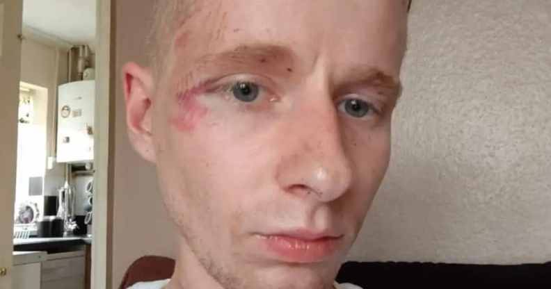 In this photograph, Nathan Esslemont can be seen with wounds on his face