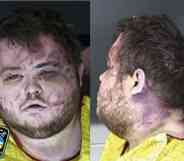 Two mugshots of the Colorado Springs shooter Anderson Lee Aldrich showing severe bruises to his face and neck