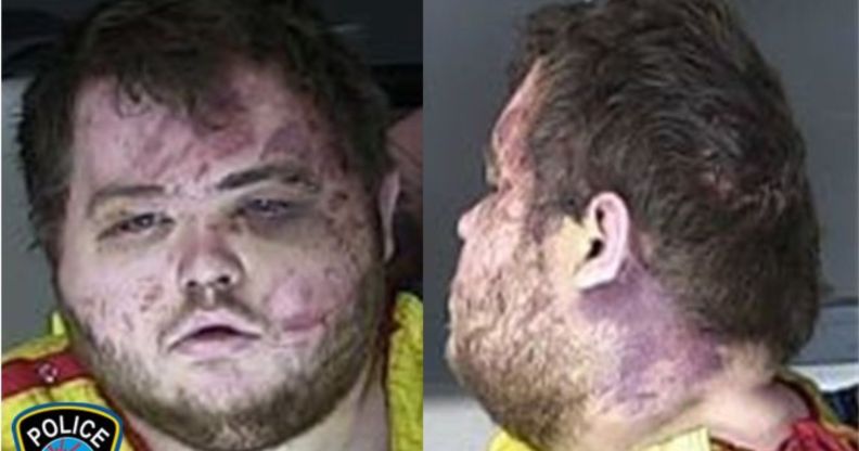 Two split images of Anderson Lee Aldrich, one a front profile, and the other a side profile, showcasing the many brusies received from the incident.