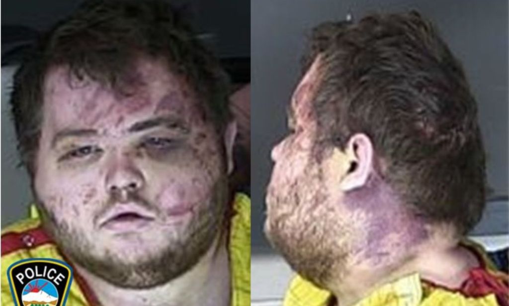 Two split images of Anderson Lee Aldrich, one a front profile, and the other a side profile, showcasing the many brusies received from the incident.