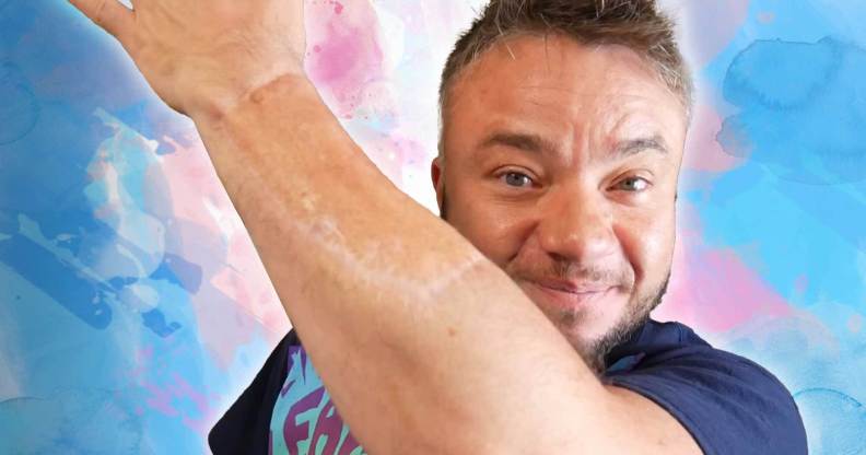 A photo of YoutTuber Finlay Games showing his skin graft, photoshopped into a trans flag made of smoke.