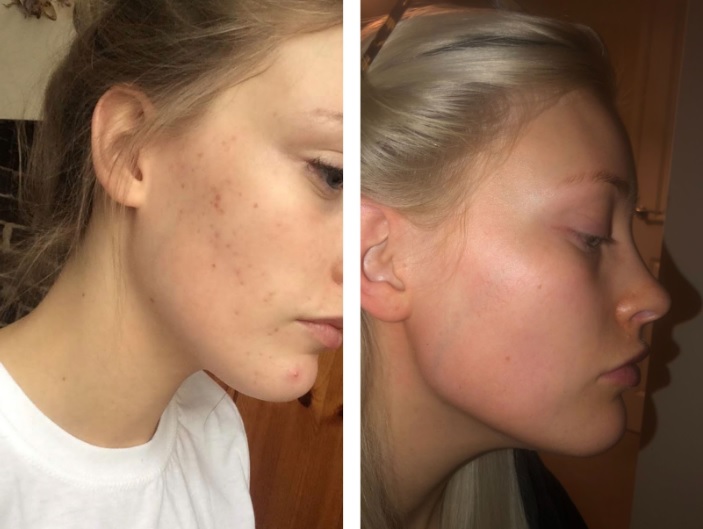 Mia Smith used the Glycolic Fix Daily Cleansing Pads and Glycolic Fix Scrub and the results speak for themselves.
