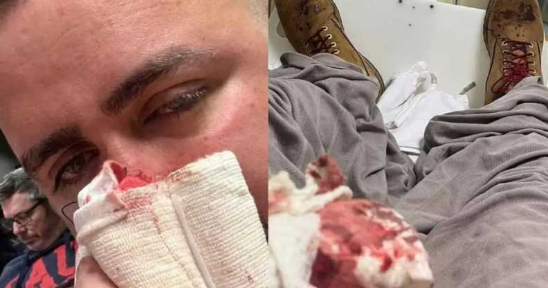 Victim of homophobic attack, Adrian Lea
