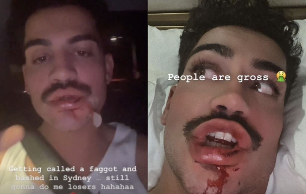 I’m A Celeb star David Subritzky left bloodied in 'homophobic' attack while on night out in Sydney