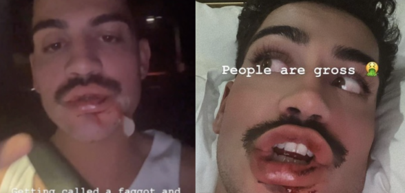 I’m A Celeb star David Subritzky left bloodied in 'homophobic' attack while on night out in Sydney