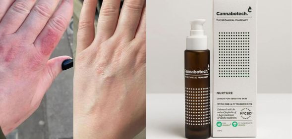 This skincare's hero ingredient duo is helping psoriasis sufferers