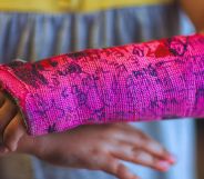 A young person with a pink cast for a broken wrist that has been drawn on.