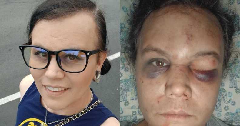 Nikki Armstrong was violently assaulted in Renton.