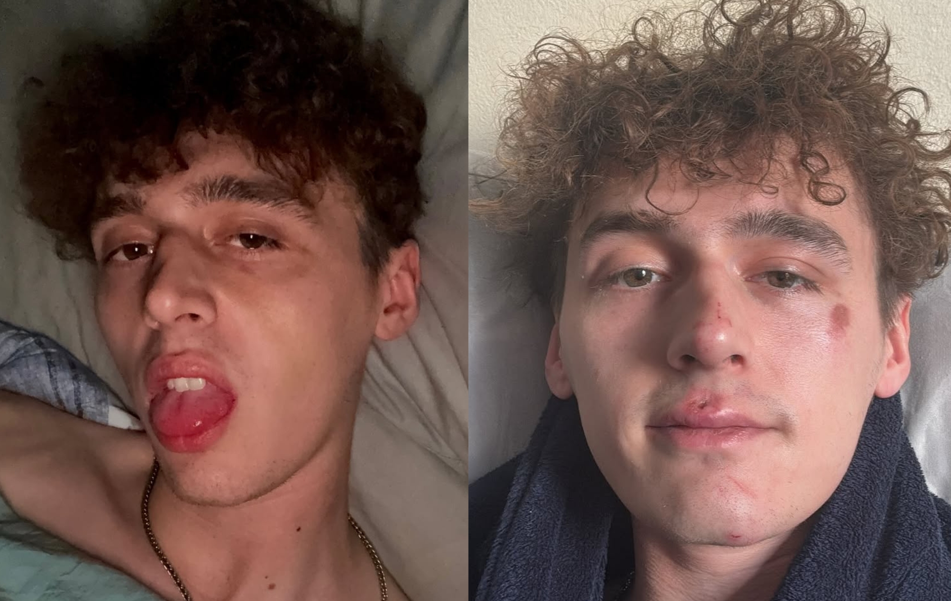 Big Brother winner left with black eye and facial injuries after homophobic attack