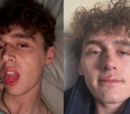 Photos from Cameron Cole's instagram showing his black eye and face cuts.