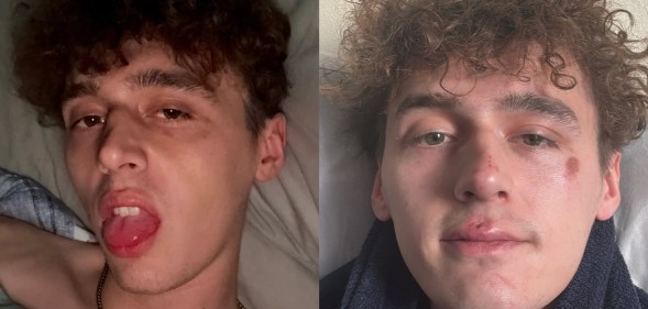 Photos from Cameron Cole's instagram showing his black eye and face cuts.