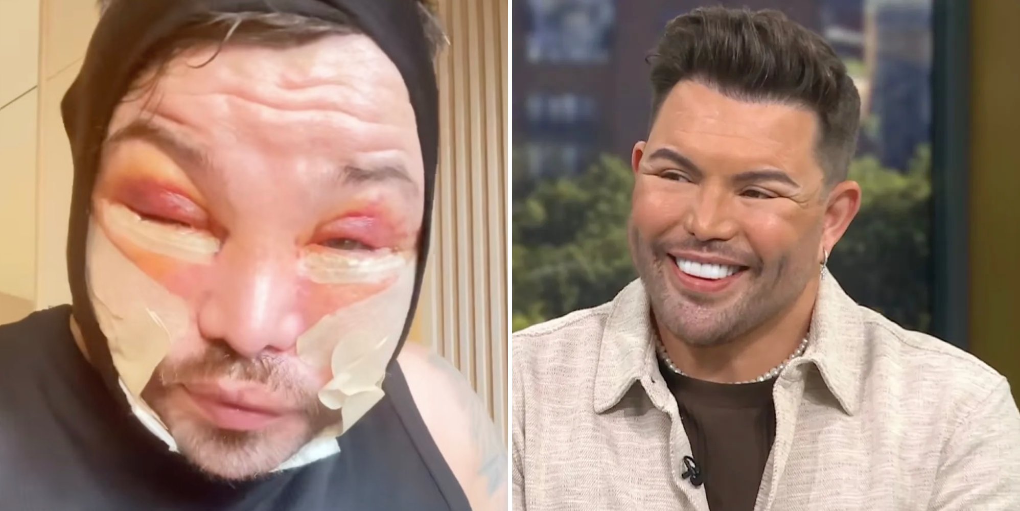 Bobby Norris Defends Facelift Criticism in Bandaged Clip